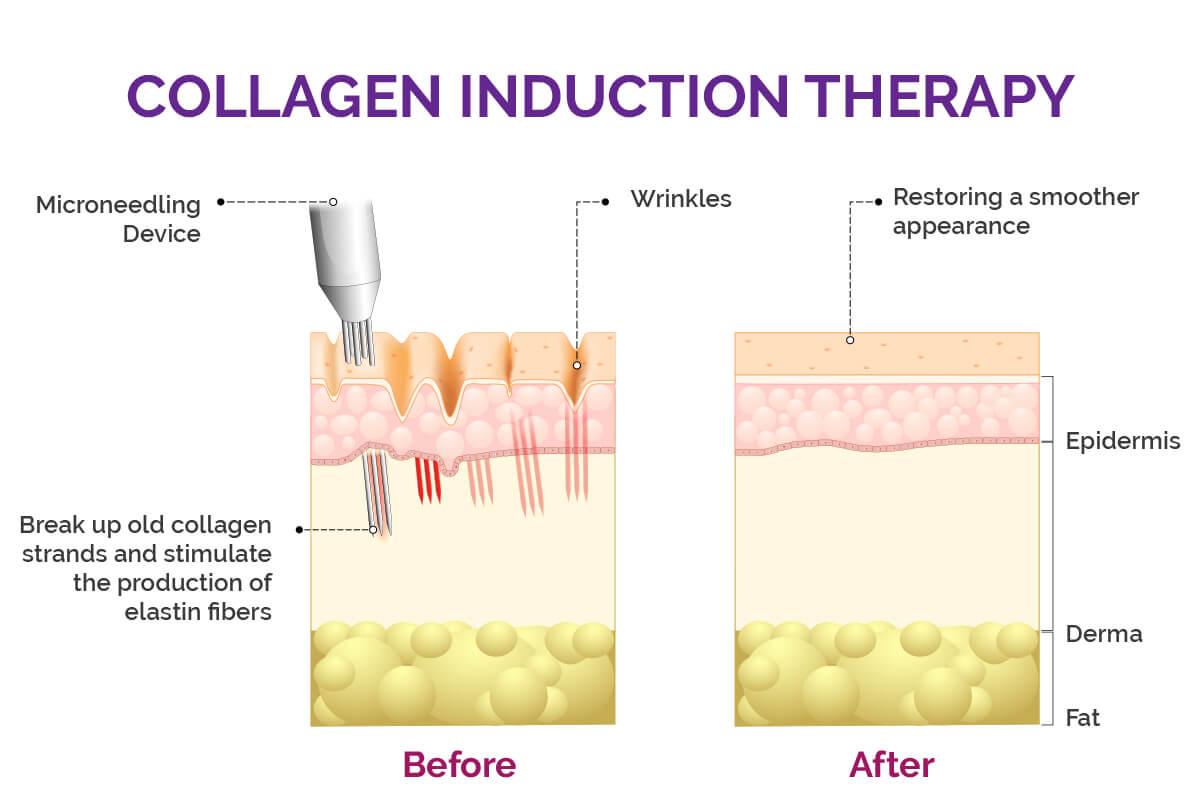 Microneedling infographic